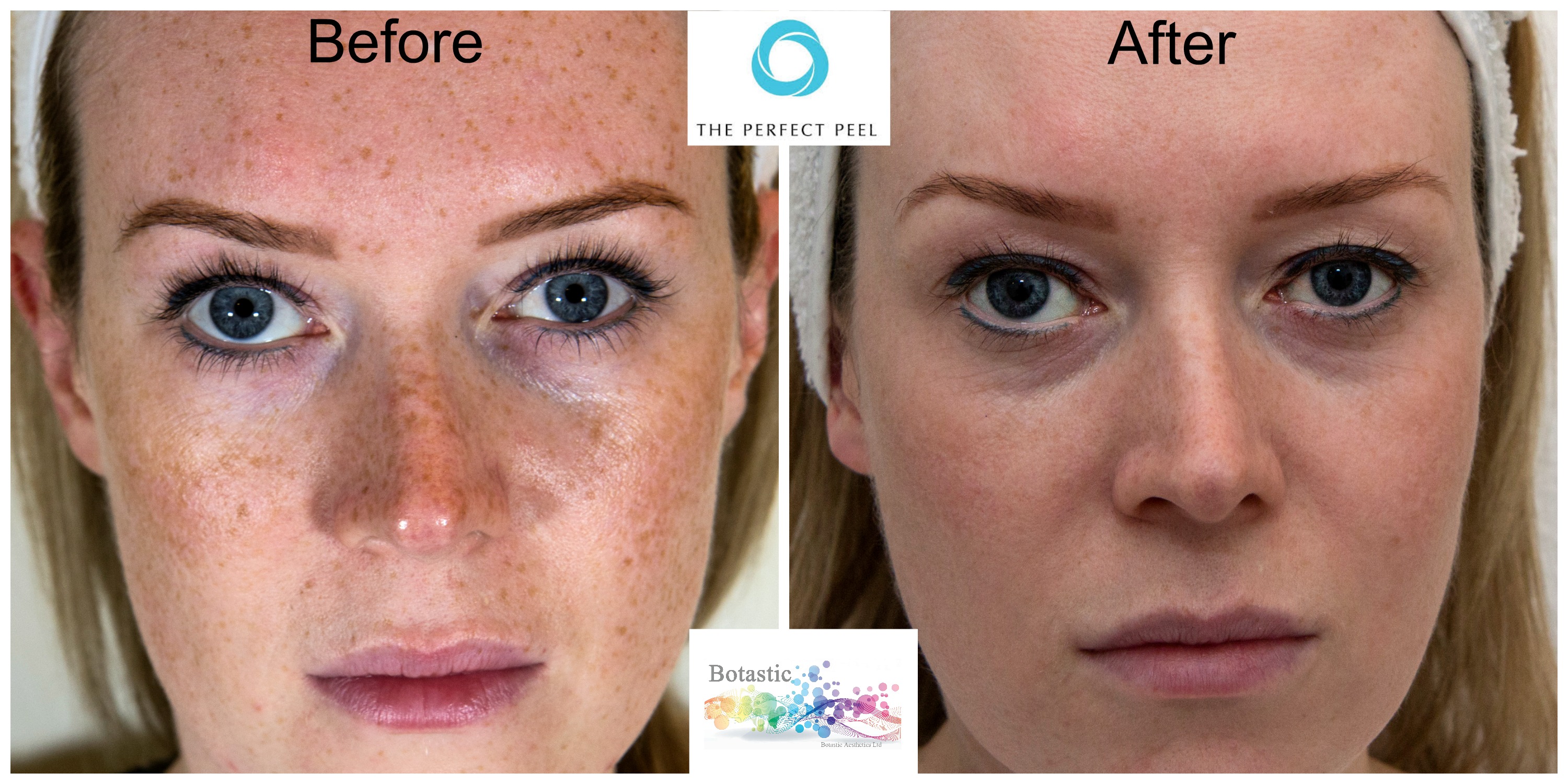 The Perfect Derma Peel Before And After Pictures