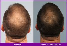 HGH Therapy to Restore Hair Loss | MetroMD