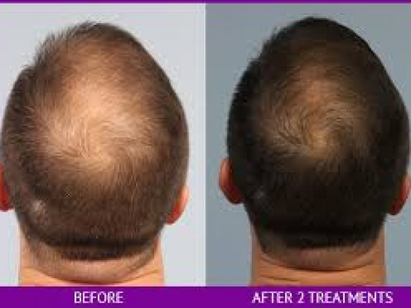 HGH Therapy to Restore Hair Loss